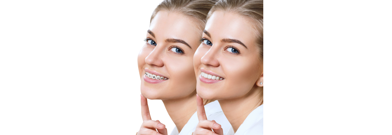 Difference Between Cosmetic and Orthodontic Braces