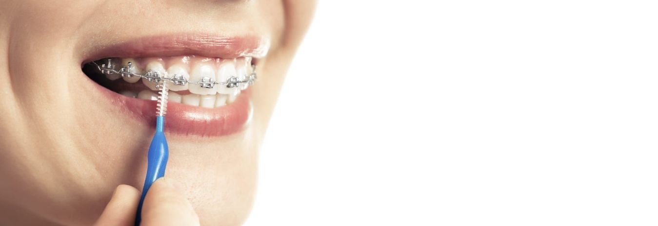Oral Hygiene for Metal Braces