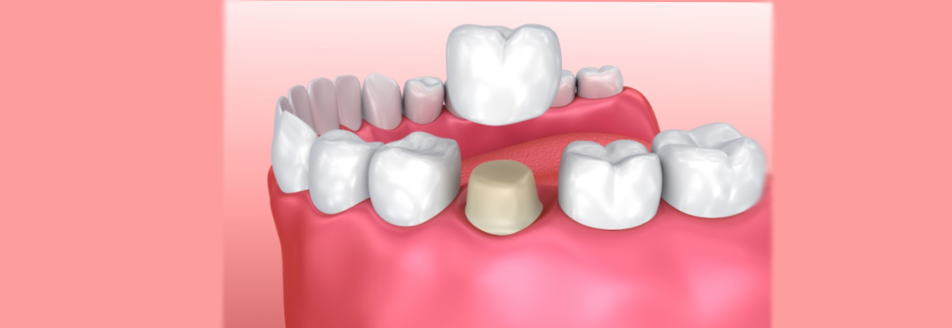 Caring for your Dental Crown