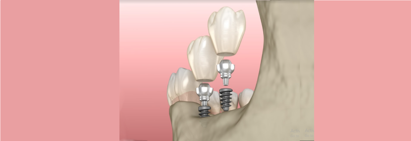 Overview: Dental Implants