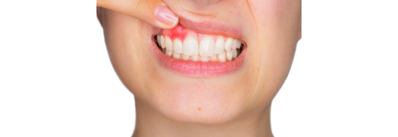 Why Might Your Gums be Throbbing in Pain?