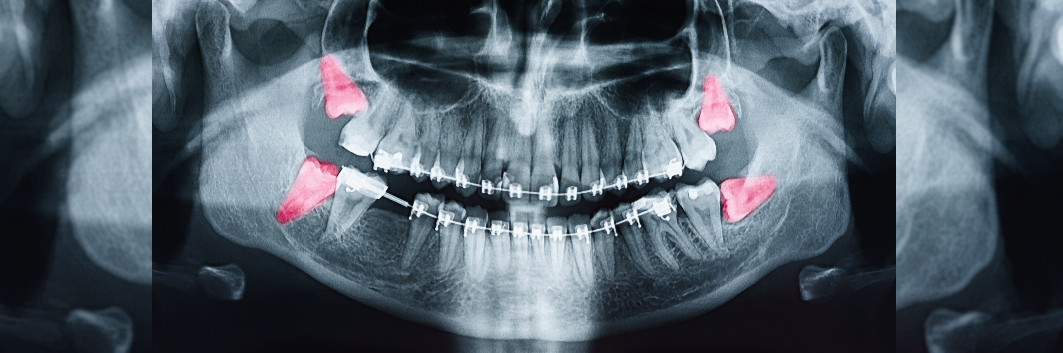Need to Know:  Impacted Wisdom Tooth